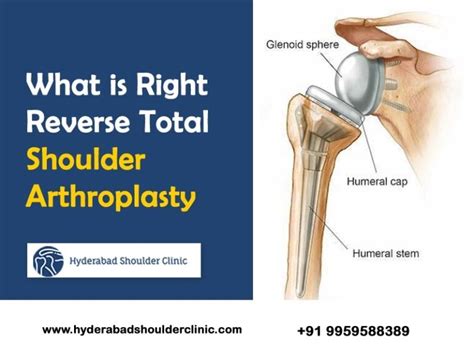 reverse total shoulder arthroplasty icd 10|Iba pa.